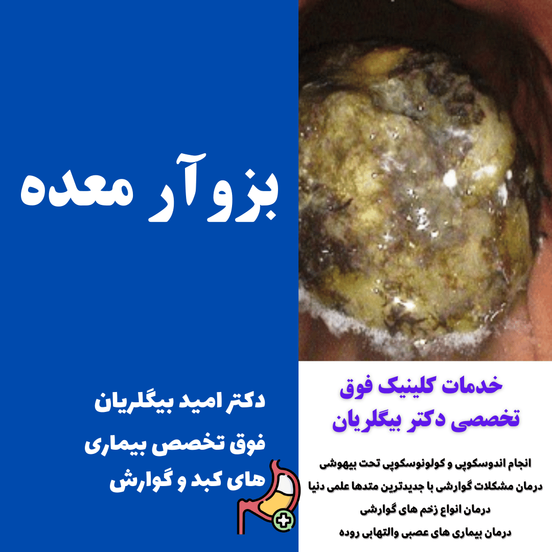 بزوآر معده