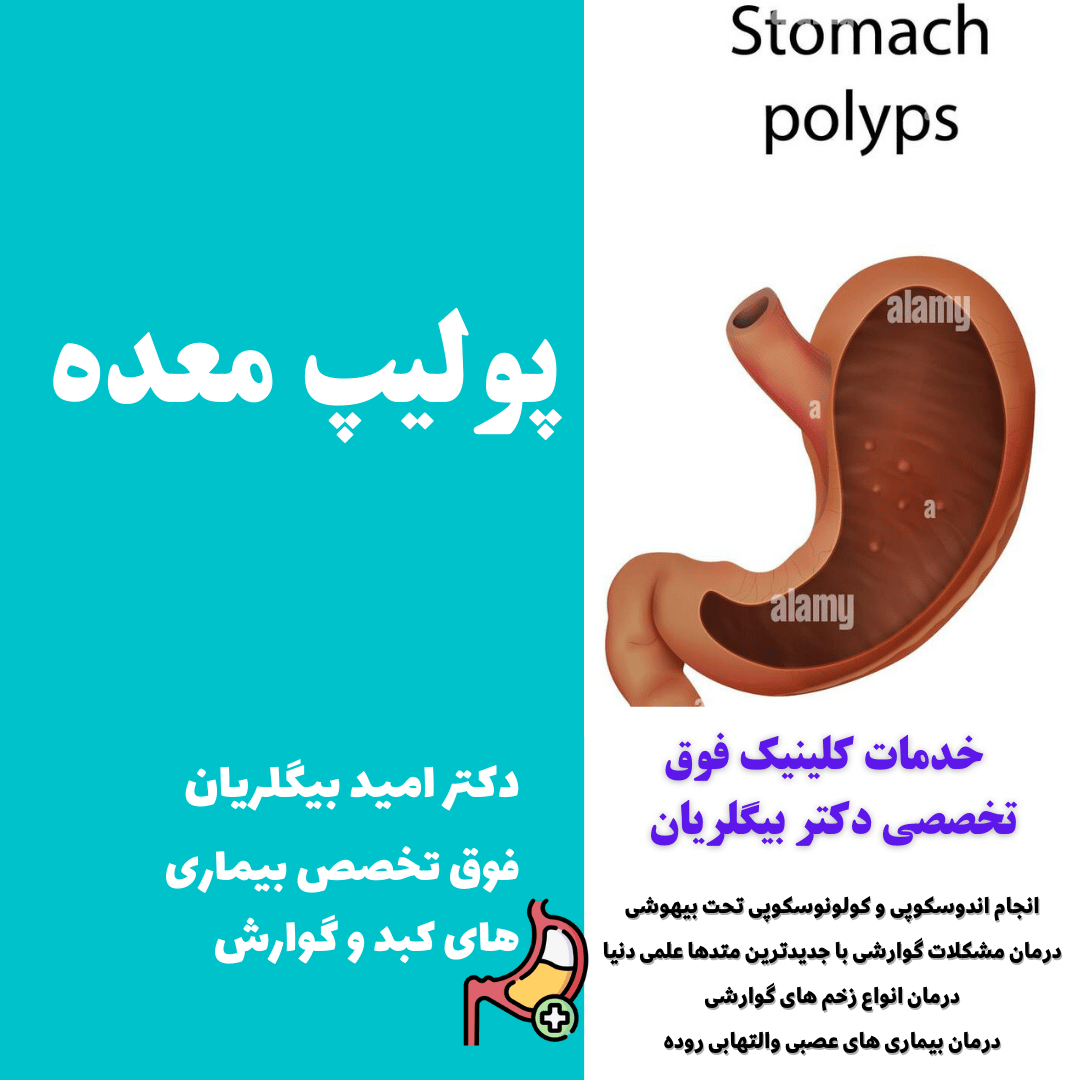 پولیپ معده