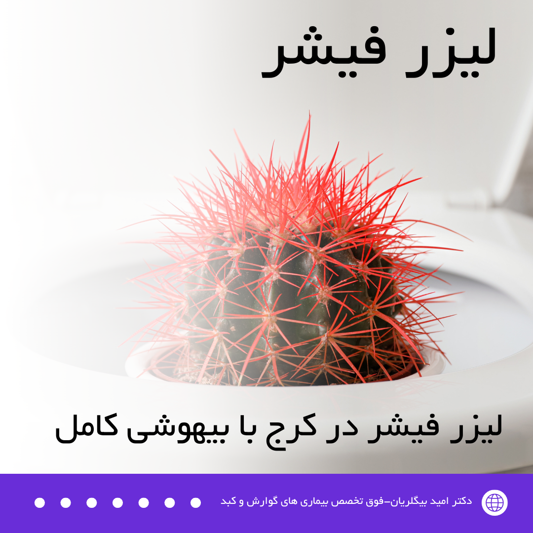 لیزر فیشر در کرج