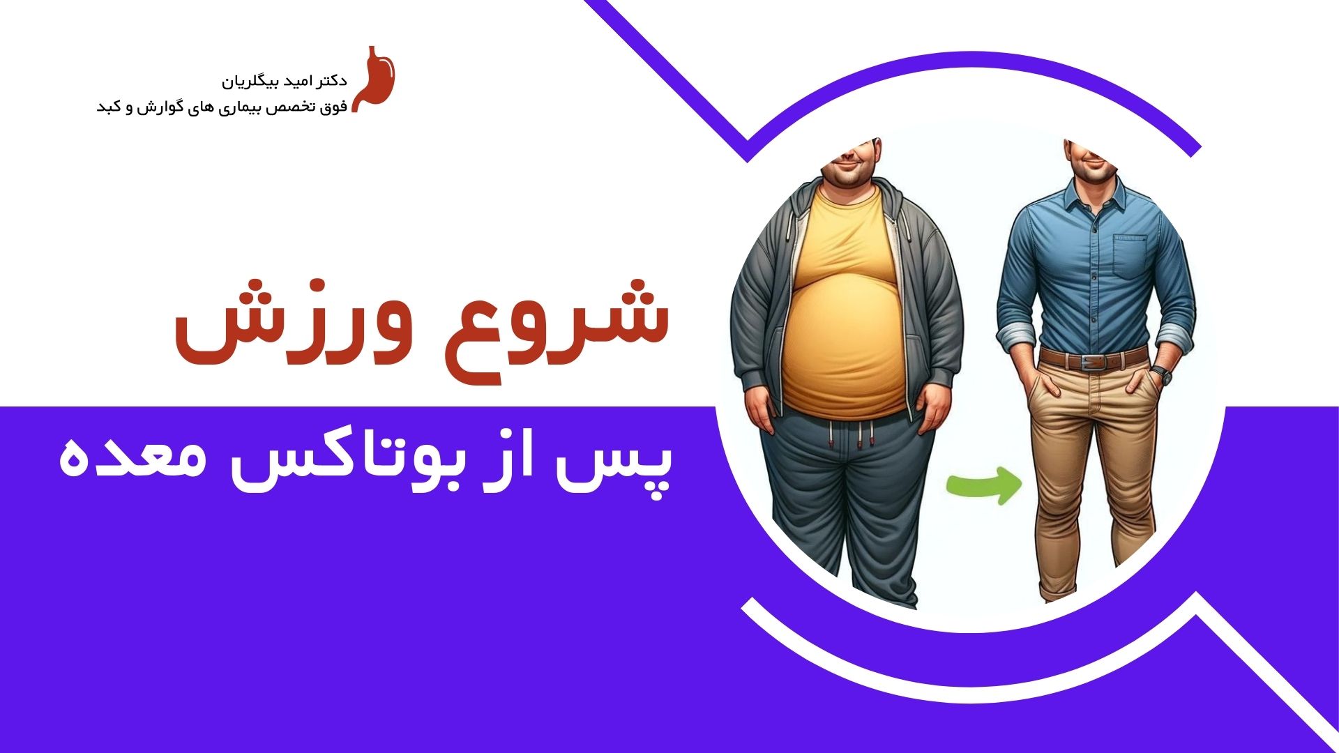 بهترین زمان شروع ورزش پس از بوتاکس معده