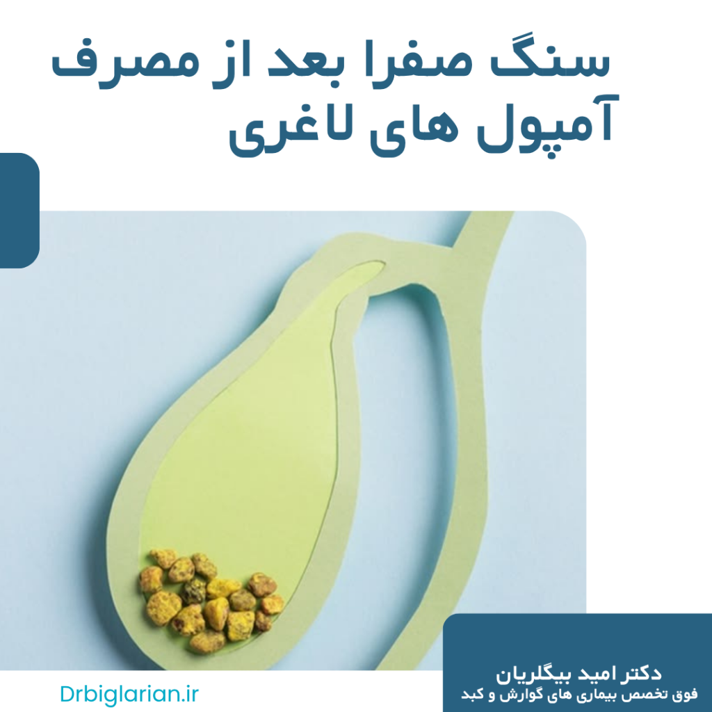 ایجاد سنگ صفرا پس از کاهش وزن با قلم های لاغری