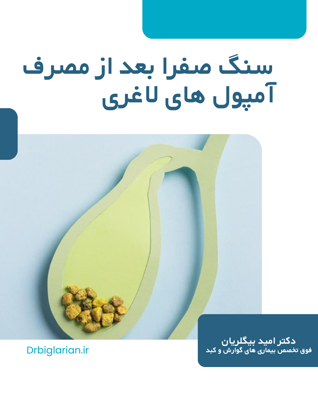 ایجاد سنگ صفرا پس از کاهش وزن با قلم های لاغری