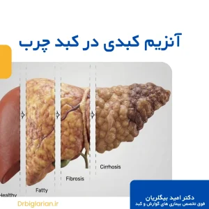 آنزیم کبدی نرمال در کبد چرب