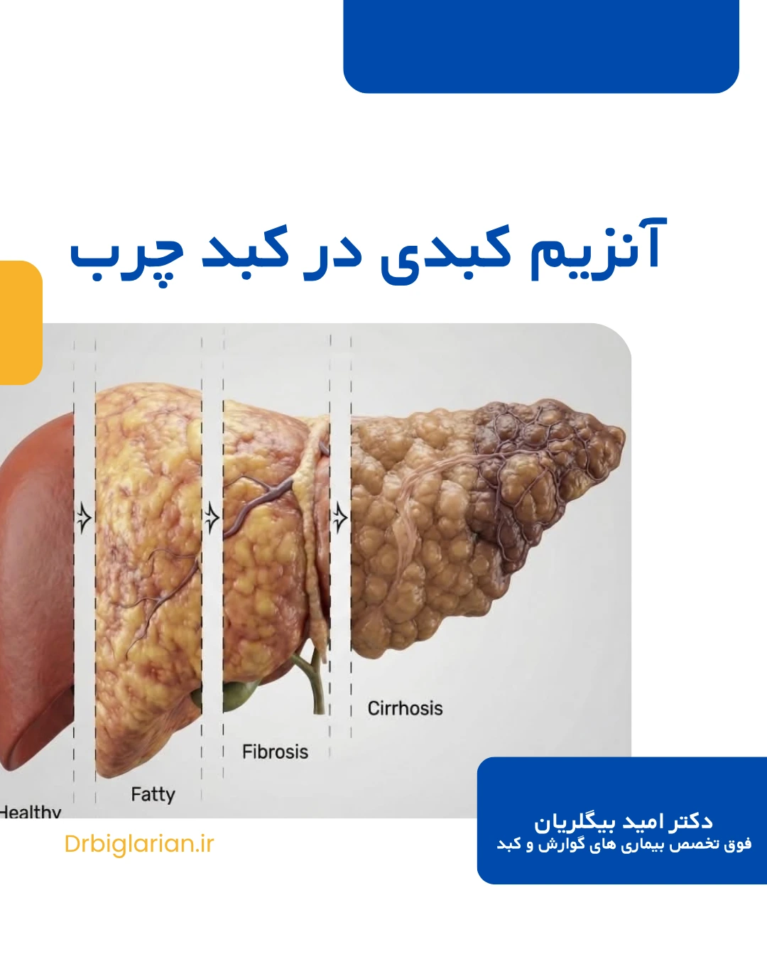 آنزیم کبدی نرمال در کبد چرب