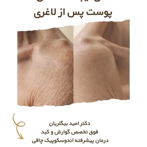 شلی پوست بعد از لاغری