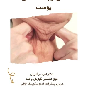 چرا پوست بعد از لاغری شل میشود